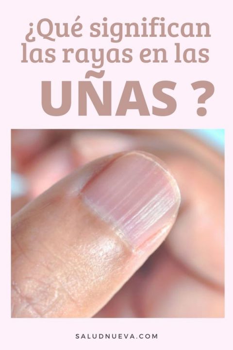 Rayas en las uñas