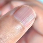 rayas en las uñas enfermedades