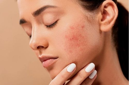 Remedio casero de cúrcuma para el acné