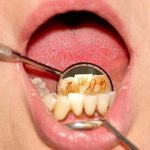remedios naturales para quitar el sarro de los dientes