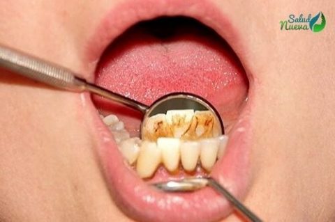 ¿Cómo quitar el sarro de los dientes de forma natural?