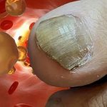 sintomas de colesterol alto en las uñas de los pies