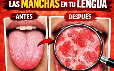 Imagen ilustrativa de lengua geográfica mostrando manchas rojas irregulares en la lengua y explicación sobre qué significa esta condición y sus posibles causas.