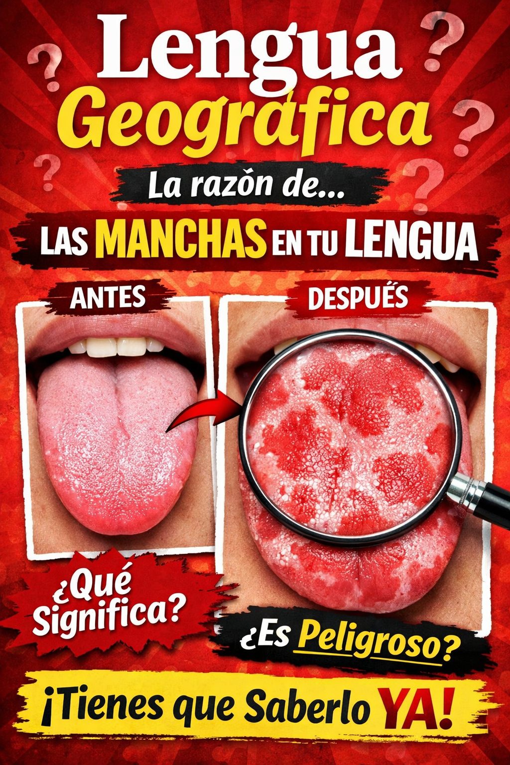 Imagen ilustrativa de lengua geográfica mostrando manchas rojas irregulares en la lengua y explicación sobre qué significa esta condición y sus posibles causas.
