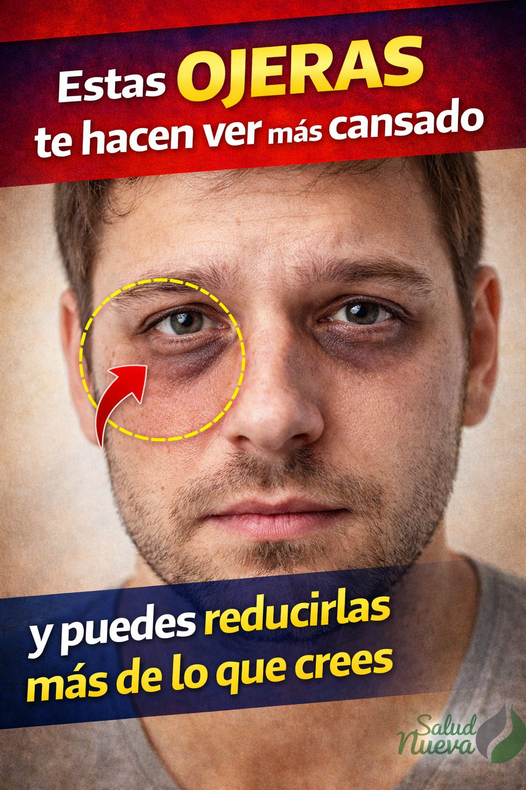 Primer plano de un hombre con ojeras oscuras visibles bajo los ojos, resaltadas con un círculo y una flecha, acompañado de texto en español sobre cómo estas ojeras hacen ver más cansado y que pueden reducirse, en diseño llamativo tipo Pinterest con logo de Salud Nueva.